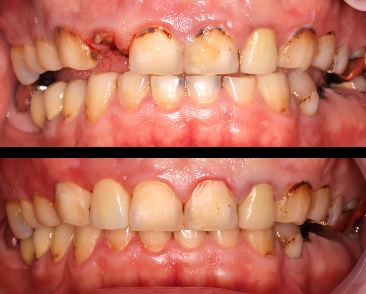 蘇先生側門牙僅殘存牙根，經牙冠增長術、全瓷冠贗復後，恢復機能與外觀