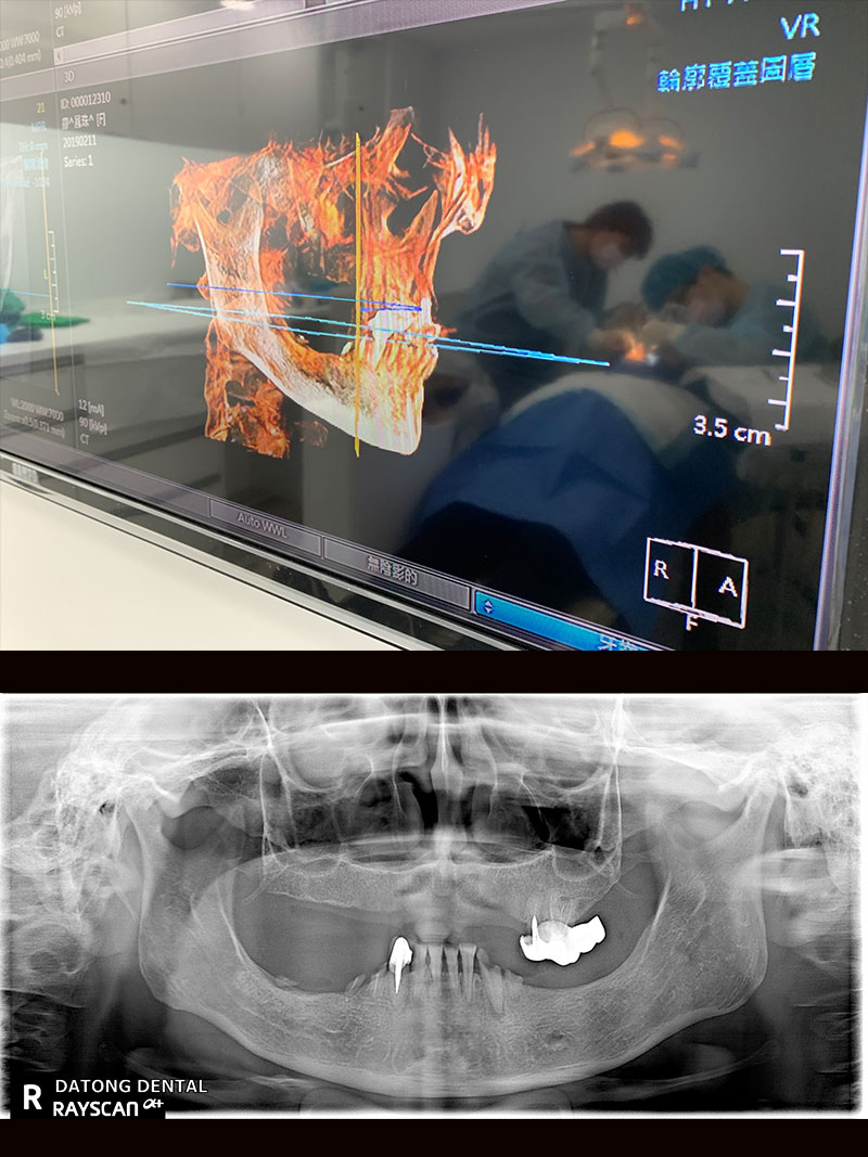 Read more about the article 林女士-植牙 全口重建
