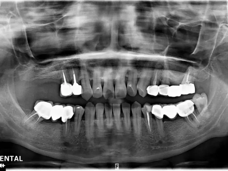 許小姐-植牙 2 植牙-許思宇-2