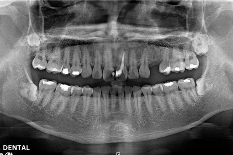 植牙案例-邱腊構-1