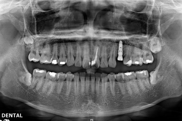 植牙案例-邱腊構-2