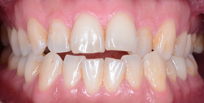 case-invisalign-1