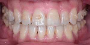 case invisalign 2