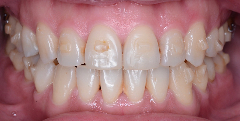 case-invisalign-2