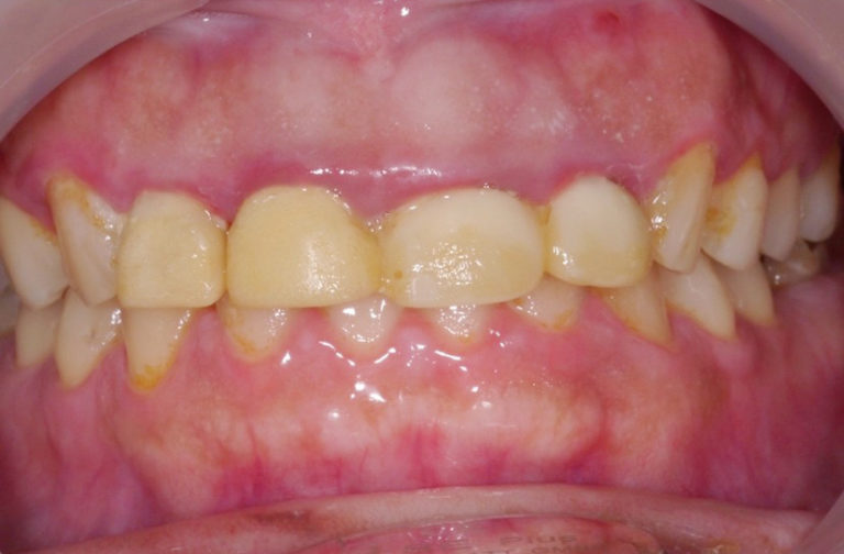 case-denture-1-1