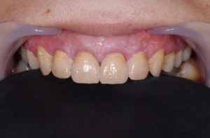 case denture 1 2