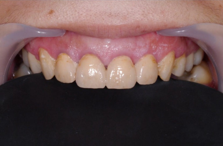 case-denture-1-2