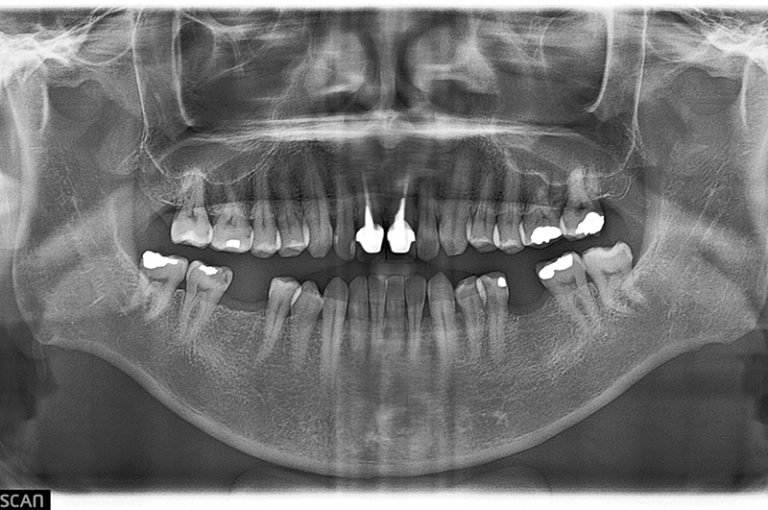 case-implant-92-1