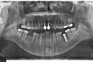 case implant 92 2