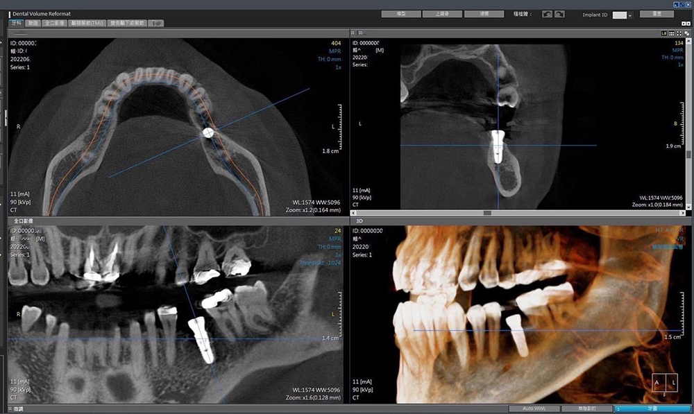 case implant 92 3