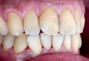 case whitening 2 2