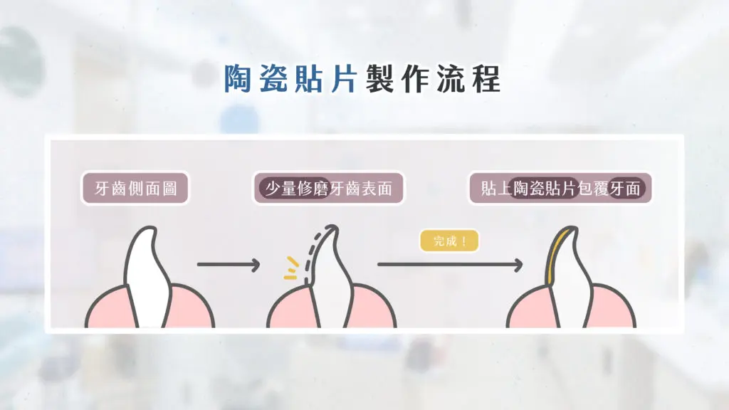 陶瓷貼片和全瓷冠,哪一種更適合我?優缺點、費用、常見問題一次搞懂 1 陶瓷貼片製作流程