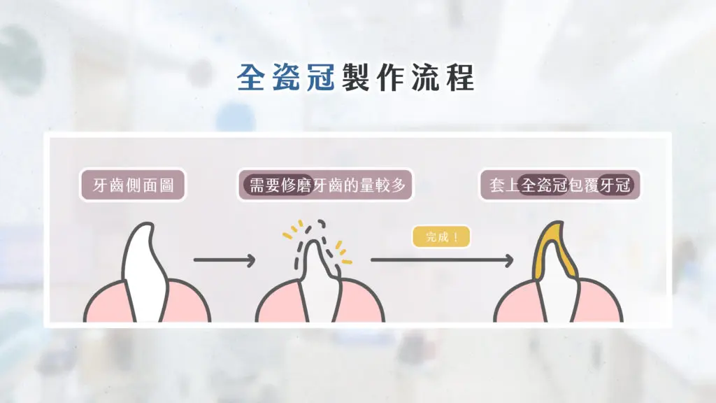 陶瓷貼片和全瓷冠,哪一種更適合我?優缺點、費用、常見問題一次搞懂 2 全瓷冠製作流程