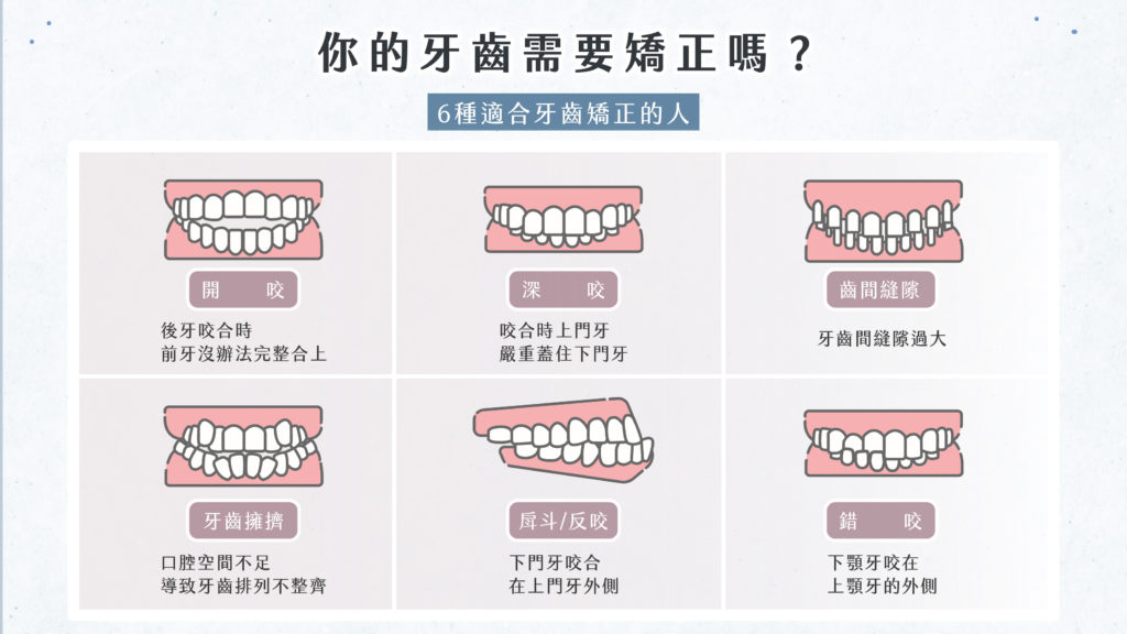 6種適合牙齒矯正的人-北大昕成