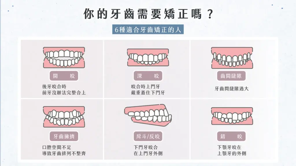 牙齒矯正有什麼好處?不只笑容變美,改善咬合更健康 1 6種適合牙齒矯正的人-北大昕成