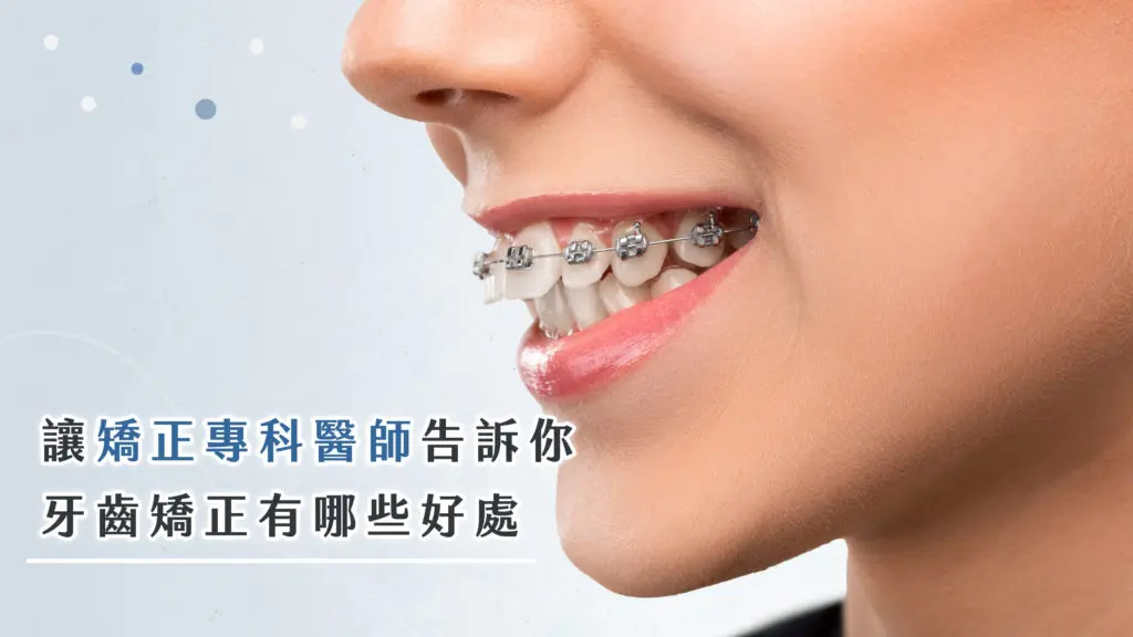牙齒矯正有什麼好處?不只笑容變美,改善咬合更健康 3 牙齒矯正好處-北大昕成