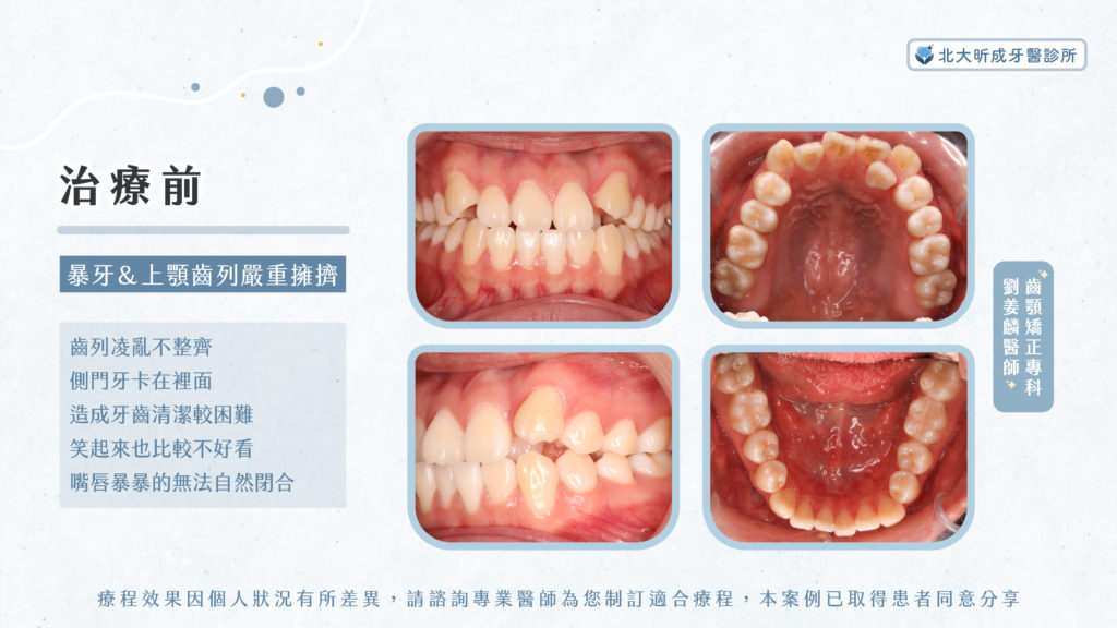 牙齒矯正案例治療前-北大昕成