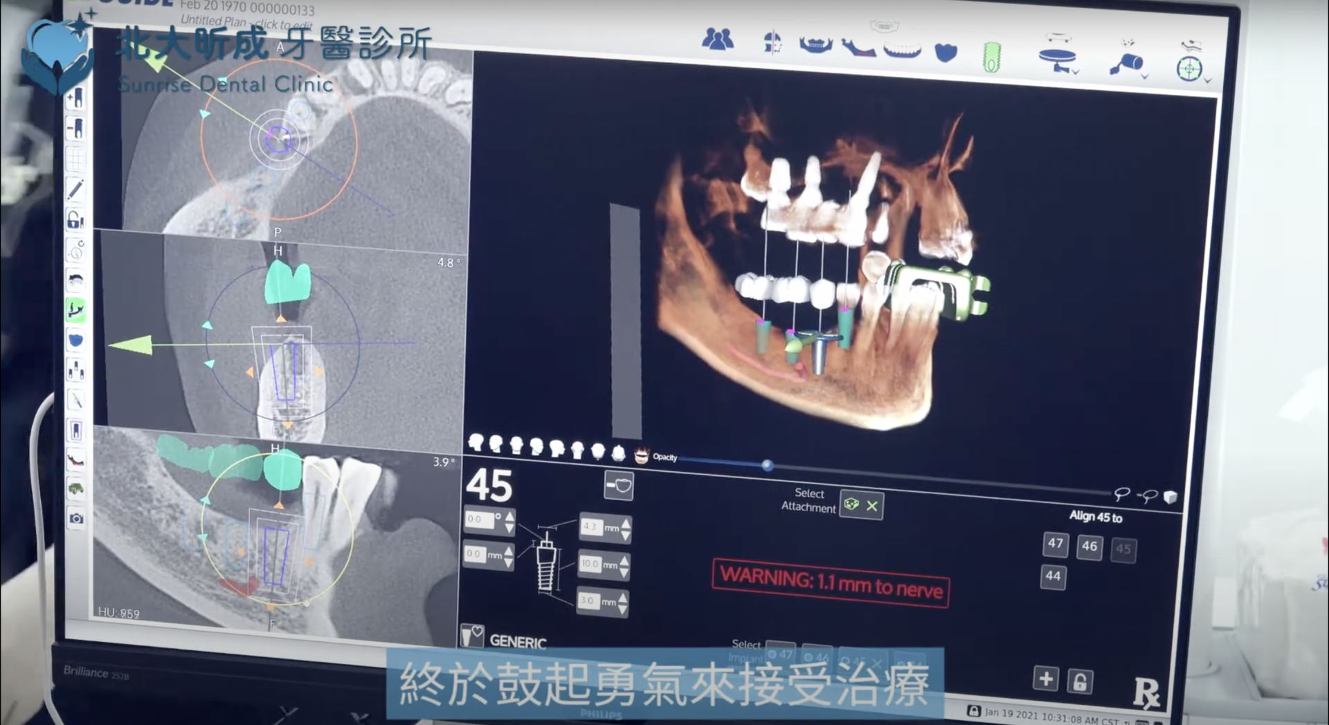 X-Guide導航植牙安全、精準又輕鬆！北大昕成給您勇氣與信心！