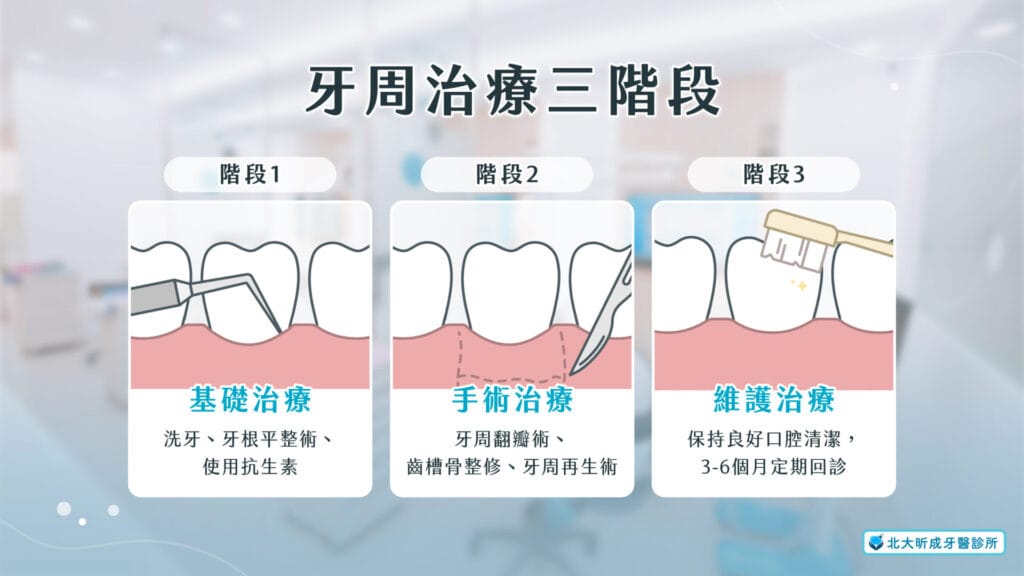 「牙周病治療三階段」痊癒沒有捷徑，一切回歸最基本的清潔與治療 | 北大牙醫推薦-北大昕成牙醫診所