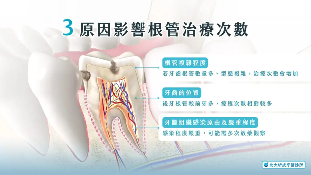 根管治療要做幾次?了解根管治療需要分次完成的原因 1 影響根管治療次數的原因-北大昕成