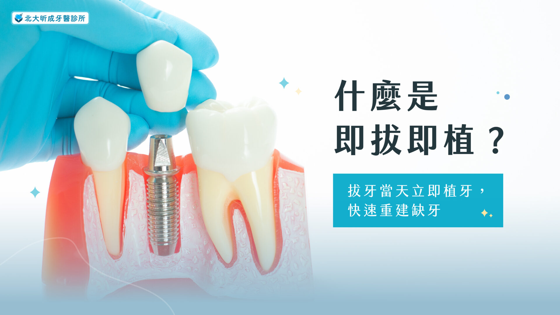 Read more about the article 什麼是即拔即植？拔牙當天立即植牙，快速重建缺牙