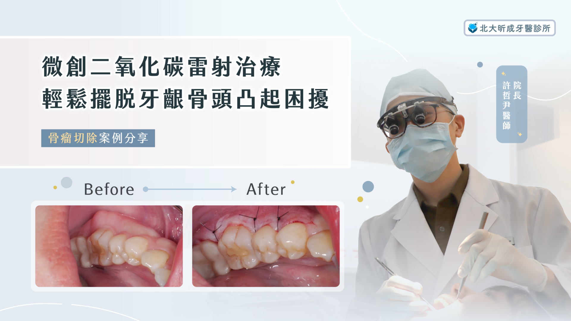 Read more about the article 雷射治療案例 — 骨瘤切除傷口處理