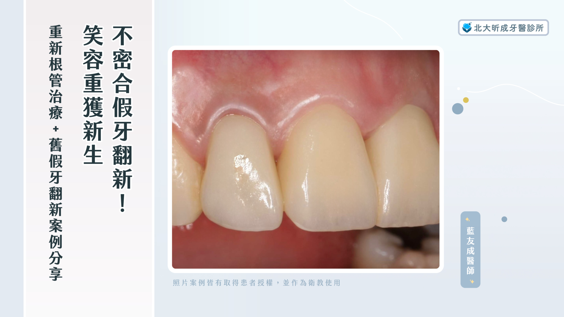 Read more about the article 不密合假牙翻新！笑容重獲新生