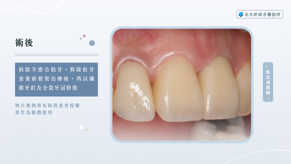 不密合假牙翻新!笑容重獲新生 2 假牙案例-北大昕成牙醫