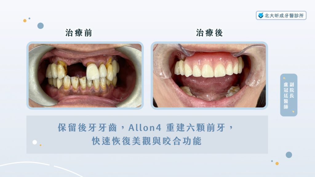 只要一天重建自信開口的尊嚴:Allon4全口重建案例 3 allon4案例-術前術後-北大昕成
